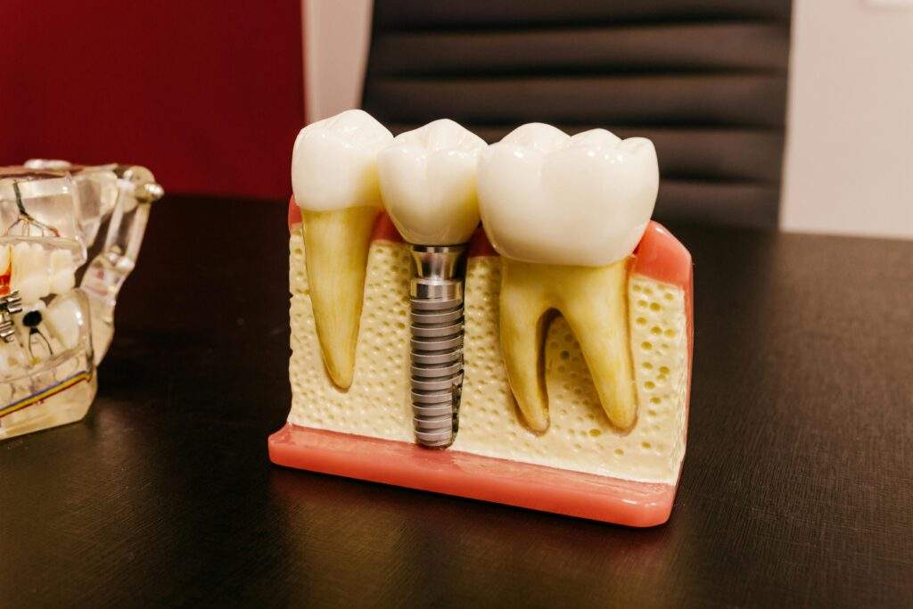 Implantes dentales: cuándo son necesarios y qué opciones existen